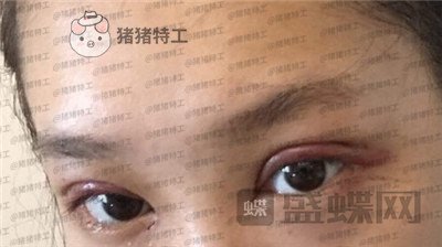 重庆美仑美奂董祥宁双眼皮案例价格分享,都说我单眼皮好看没想到双眼皮更美~
