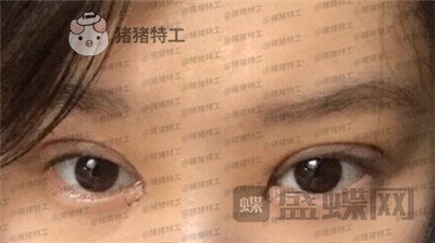 重庆美仑美奂董祥宁双眼皮案例价格分享,都说我单眼皮好看没想到双眼皮更美~