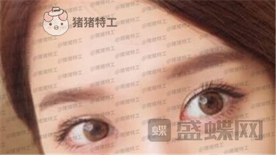 重庆美仑美奂董祥宁双眼皮案例价格分享,都说我单眼皮好看没想到双眼皮更美~