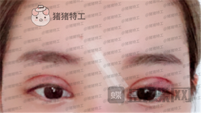 深圳美莱周洪超双眼皮案例价格分享,了解到有双闪闪大眼睛有多重要。