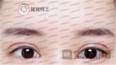 深圳美莱周洪超双眼皮案例价格分享,了解到有双闪闪大眼睛有多重要。