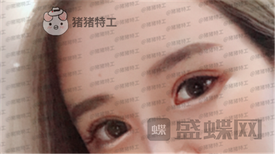 深圳美莱周洪超双眼皮案例价格分享,了解到有双闪闪大眼睛有多重要。