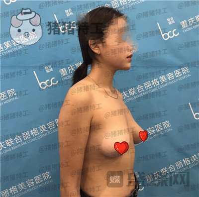 重庆联合丽格党宁隆胸案例价格分享,假体好还是自体脂肪好?适合自己较好。