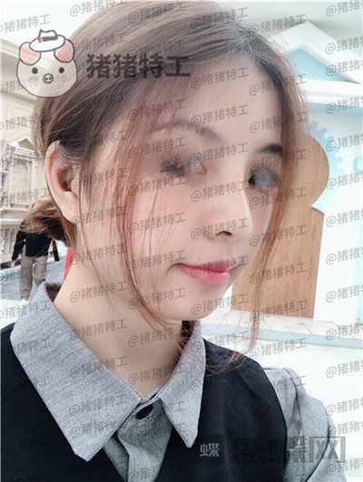 广州曙光蒋思军鼻部手术隆鼻案例价格分享,模特小姐姐对自己的要求太高了!