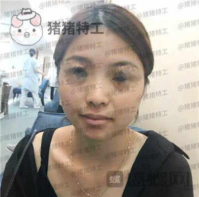 广州曙光蒋思军鼻部手术隆鼻案例价格分享,模特小姐姐对自己的要求太高了!