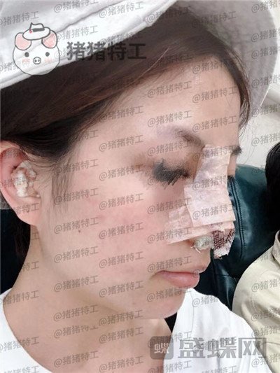 广州曙光蒋思军鼻部手术隆鼻案例价格分享,模特小姐姐对自己的要求太高了!