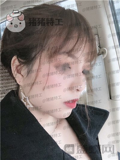 广州曙光蒋思军鼻部手术隆鼻案例价格分享,模特小姐姐对自己的要求太高了!