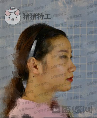 南宁美丽焦点焦俊光鼻部手术隆鼻案例价格分享,原来女神都是这么来的?