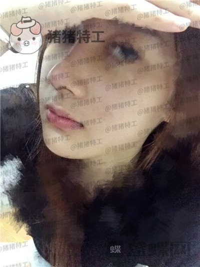 南宁美丽焦点焦俊光鼻部手术隆鼻案例价格分享,原来女神都是这么来的?
