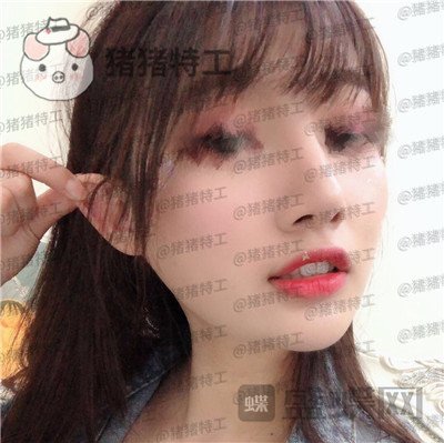 南宁美丽焦点焦俊光鼻部手术隆鼻案例价格分享,原来女神都是这么来的?