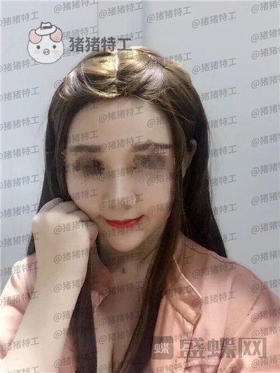 重庆中民孙刚隆鼻案例价格分享,之前的扁脸终于改变了。