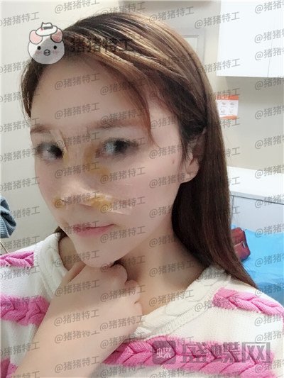 重庆中民孙刚隆鼻案例价格分享,之前的扁脸终于改变了。