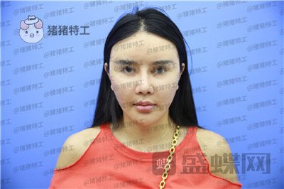 上海喜美王会勇隆鼻修复案例价格分享,跟以前的我比简直天差地别。