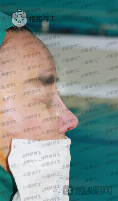 上海喜美王会勇隆鼻修复案例价格分享,跟以前的我比简直天差地别。