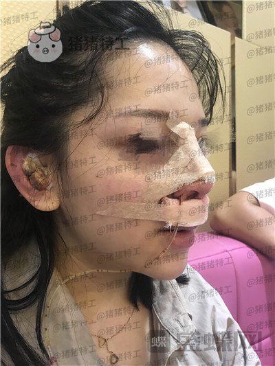 厦门福华金贵香鼻部手术案例价格分享,做完鼻子竟然年轻了这么多?