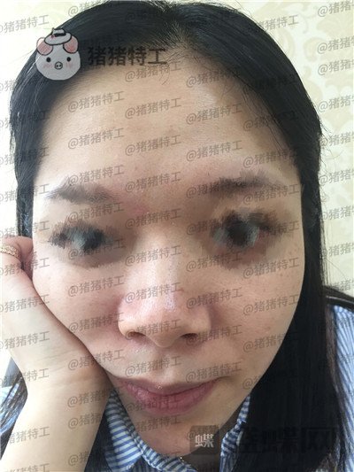 厦门福华金贵香鼻部手术案例价格分享,做完鼻子竟然年轻了这么多?