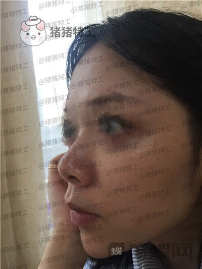 厦门福华金贵香鼻部手术案例价格分享,做完鼻子竟然年轻了这么多?