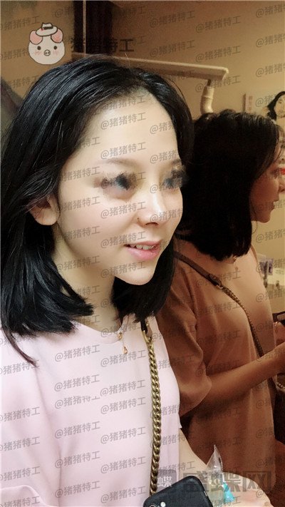 厦门福华金贵香鼻部手术案例价格分享,做完鼻子竟然年轻了这么多?