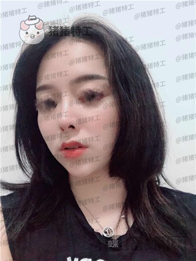 厦门福华金贵香鼻部手术案例价格分享,做完鼻子竟然年轻了这么多?