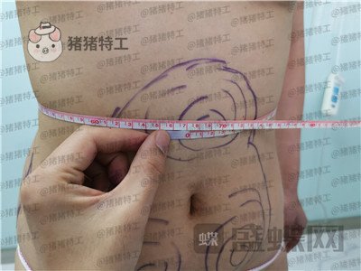长春盛羽国际杨本阳吸脂案例价格分享,水桶变水蛇你看看有多夸张这个果。