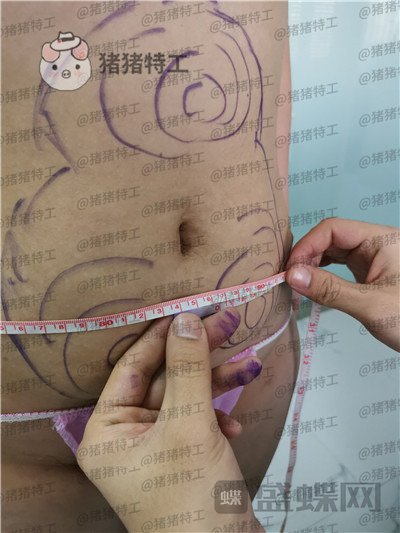 长春盛羽国际杨本阳吸脂案例价格分享,水桶变水蛇你看看有多夸张这个果。