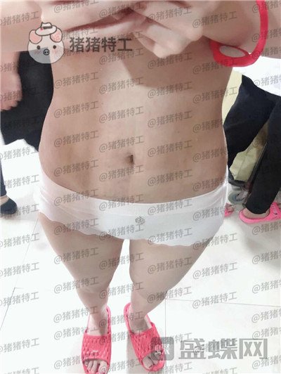 长春盛羽国际杨本阳吸脂案例价格分享,水桶变水蛇你看看有多夸张这个果。