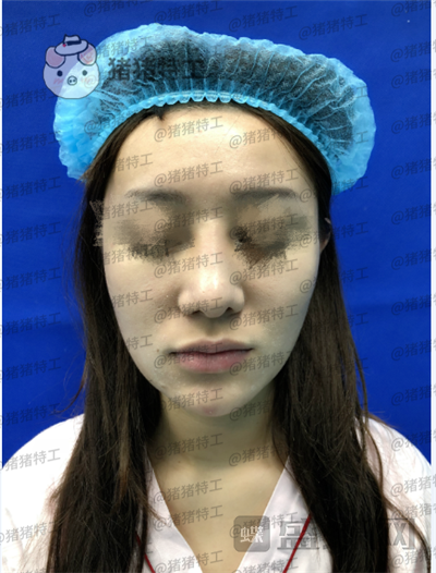 北京百达丽上海九院硕士苏婷隆鼻修复案例价格分享,因为是模特所以对鼻子要求很高。