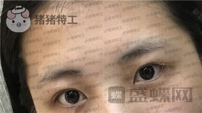 北京长虹张守玲双眼皮案例价格分享,对比之前照片就像换头术~