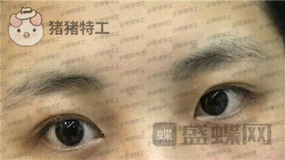 北京长虹张守玲双眼皮案例价格分享,对比之前照片就像换头术~