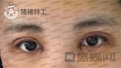 北京长虹张守玲双眼皮案例价格分享,对比之前照片就像换头术~