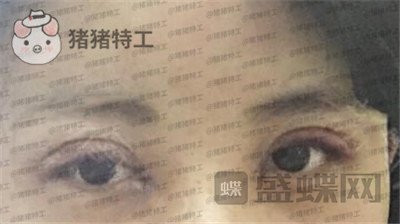 北京长虹张守玲双眼皮案例价格分享,对比之前照片就像换头术~