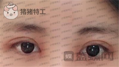 北京长虹张守玲双眼皮案例价格分享,对比之前照片就像换头术~