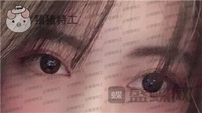 北京长虹张守玲双眼皮案例价格分享,对比之前照片就像换头术~