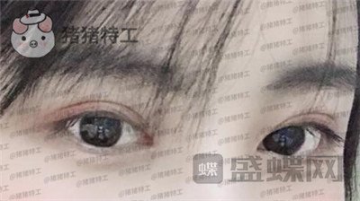 北京长虹张守玲双眼皮案例价格分享,对比之前照片就像换头术~