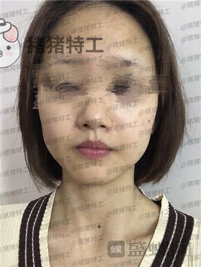 成都美容整形李静面部填充案例价格分享,感觉没果医生说两三个月才能看出来。