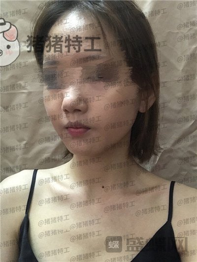 成都美容整形李静面部填充案例价格分享,感觉没果医生说两三个月才能看出来。