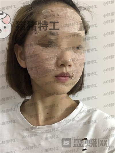 成都美容整形李静面部填充案例价格分享,感觉没果医生说两三个月才能看出来。