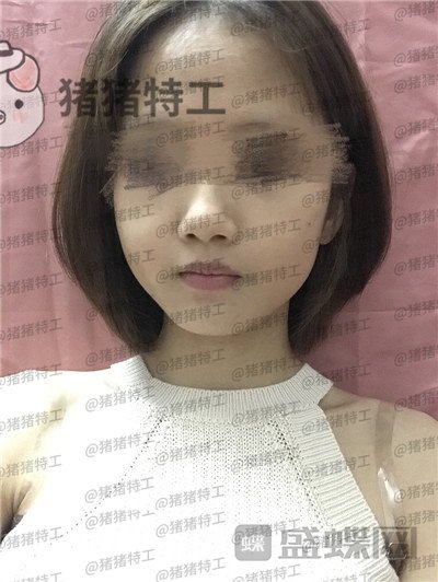 成都美容整形李静面部填充案例价格分享,感觉没果医生说两三个月才能看出来。