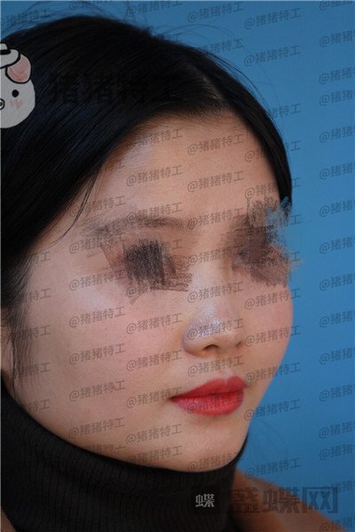 武汉同济曾宁隆鼻案例价格分享,亲戚朋友都说我这个鼻部手术做的值!