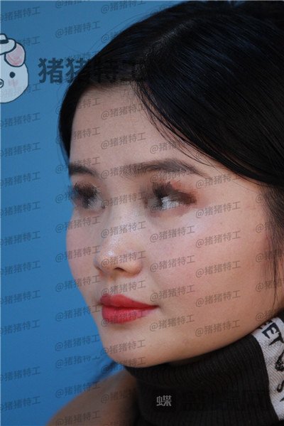 武汉同济曾宁隆鼻案例价格分享,亲戚朋友都说我这个鼻部手术做的值!