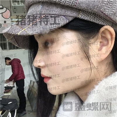武汉同济曾宁隆鼻案例价格分享,亲戚朋友都说我这个鼻部手术做的值!