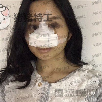 武汉同济曾宁隆鼻案例价格分享,亲戚朋友都说我这个鼻部手术做的值!