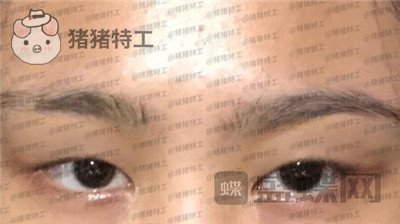 杭州美莱韩超双眼皮案例价格分享,做了眼睛变美享受爱情的滋润一切都很美好~
