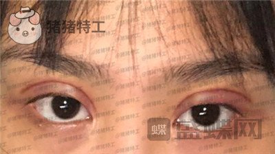 杭州美莱韩超双眼皮案例价格分享,做了眼睛变美享受爱情的滋润一切都很美好~