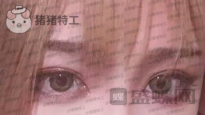 杭州美莱韩超双眼皮案例价格分享,做了眼睛变美享受爱情的滋润一切都很美好~