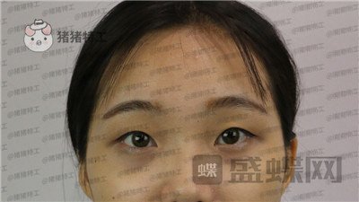 长沙亚韩郑京湘双眼皮案例价格分享,忘记自己做过双眼皮像是自己天生的。