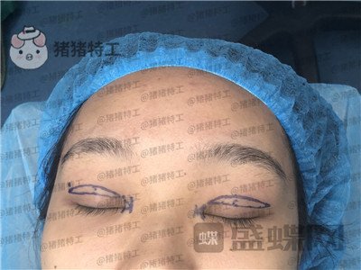 长沙亚韩郑京湘双眼皮案例价格分享,忘记自己做过双眼皮像是自己天生的。