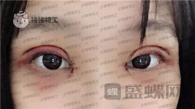长沙亚韩郑京湘双眼皮案例价格分享,忘记自己做过双眼皮像是自己天生的。