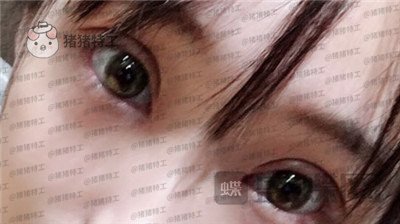 长沙亚韩郑京湘双眼皮案例价格分享,忘记自己做过双眼皮像是自己天生的。