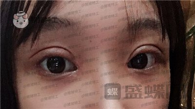 长沙亚韩郑京湘双眼皮案例价格分享,忘记自己做过双眼皮像是自己天生的。